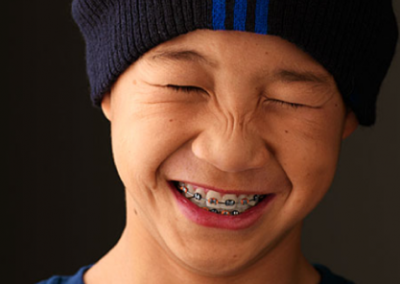 Foods to Avoid While Wearing Braces